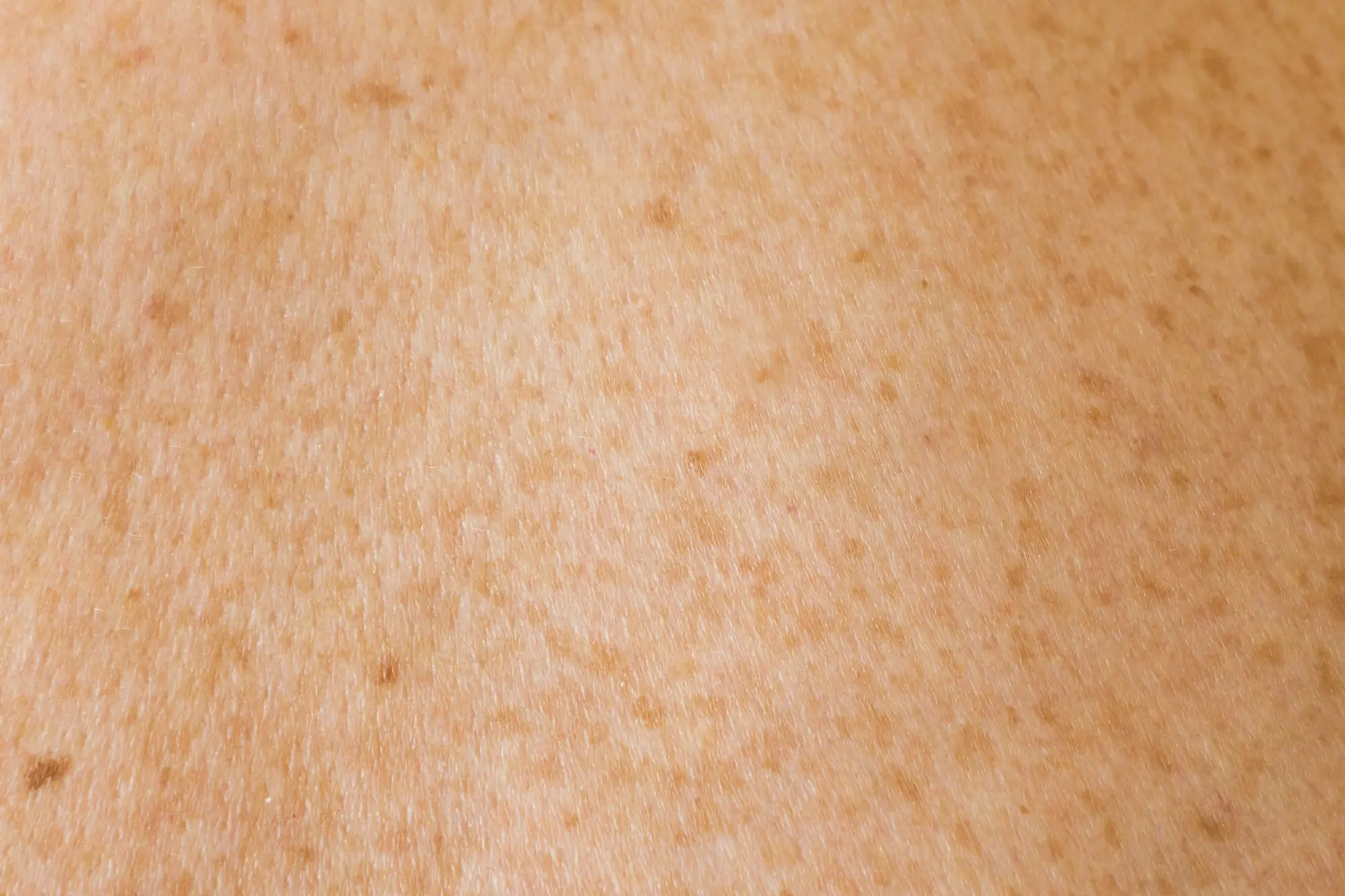 Detalle de piel con hiperpigmentación