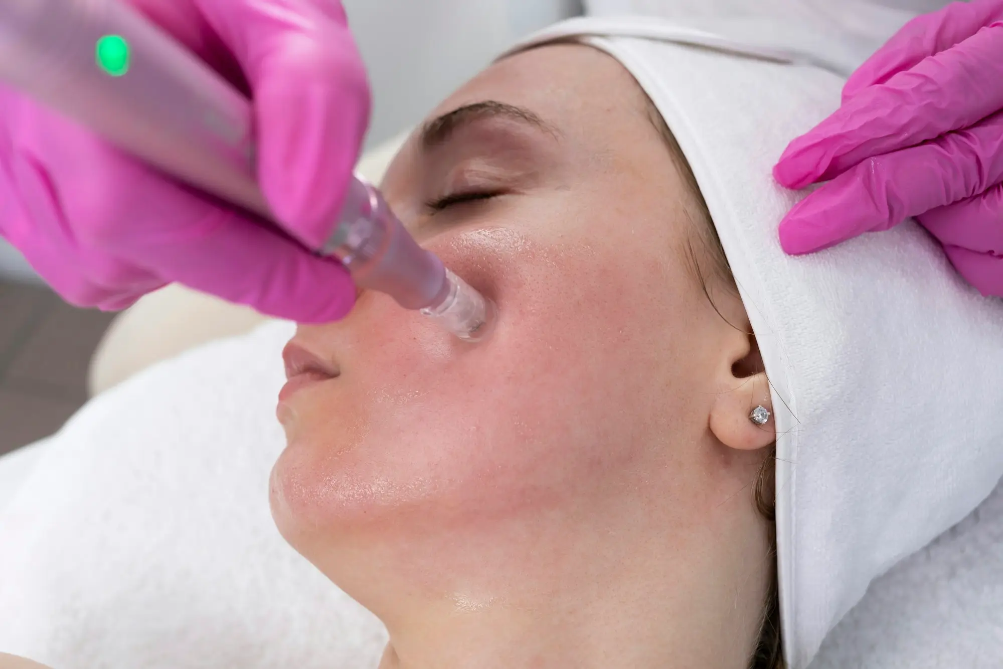 Paciente recibiendo un tratamiento de microneedling facial