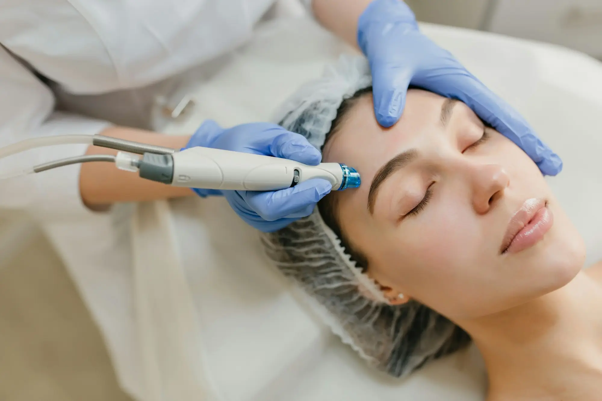 Aplicación de un peeling en el rostro de una paciente